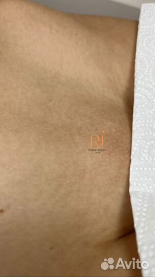 Лазерная эпиляция обучение