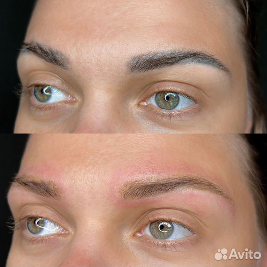 Удаление татуажа лазером