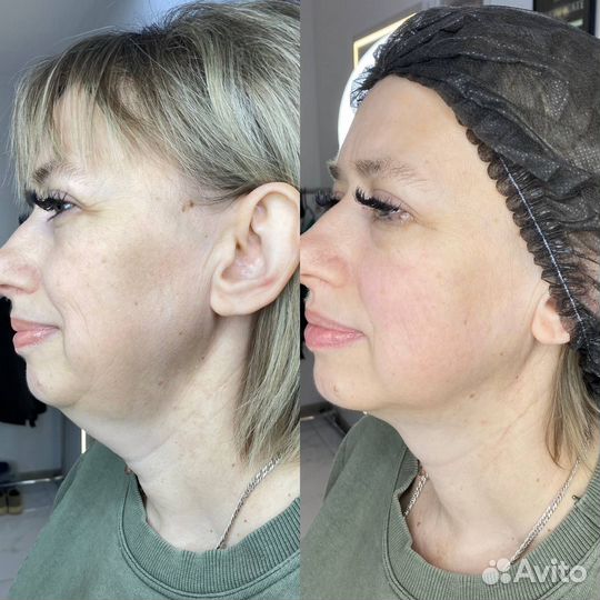 Модели SMAS лифтинг