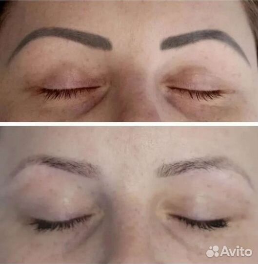 Модель на удаление тату и перманентного макияжа