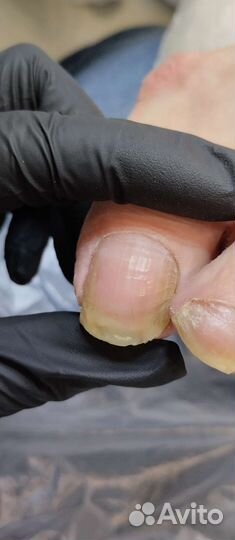 Обработка вросших ногтей и онихолизиса