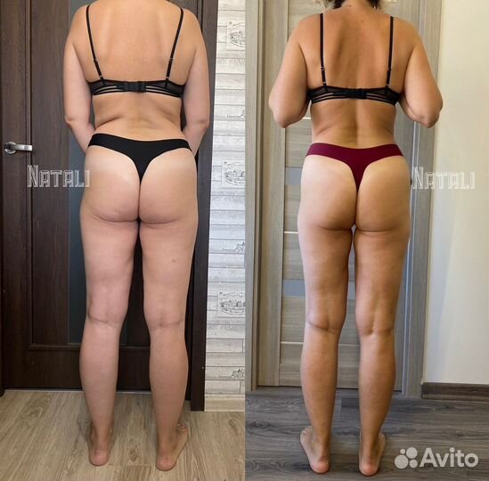 Антицеллюлитный Массаж: ручной и аппаратный