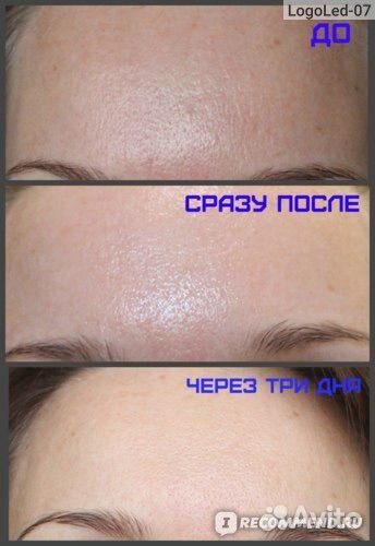 Лазерный карбоновый пилинг