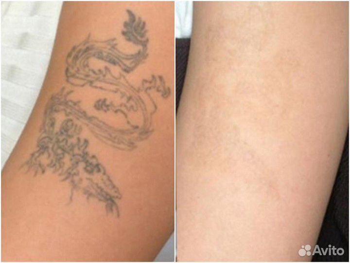 Лазерное Удаление тату и татуажа