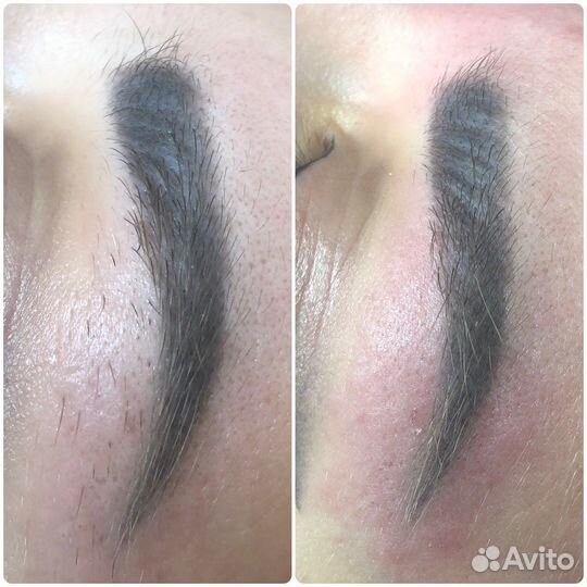 Электроэпиляция (женская/мужская). Игла включена