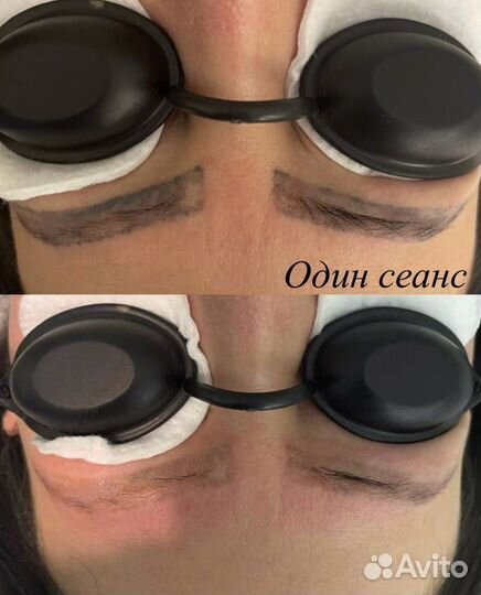 Лазерное Удаление тату и татуажа