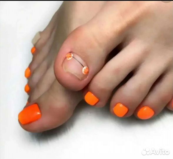 Лечение вросшего ногтя. Медицинский педикюр