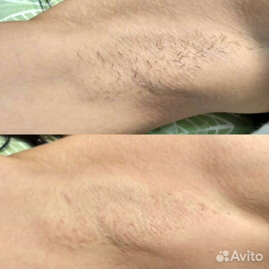 Электроэпиляция