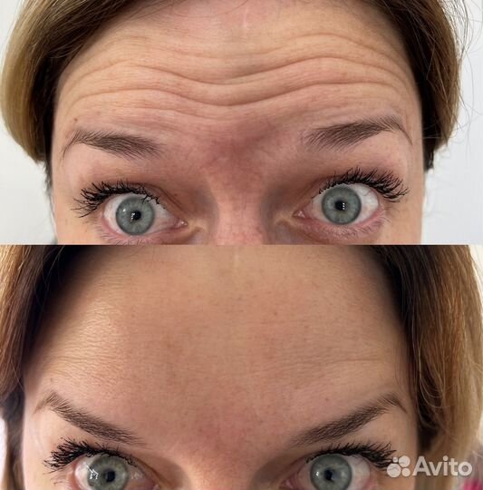 Ботокс для лица