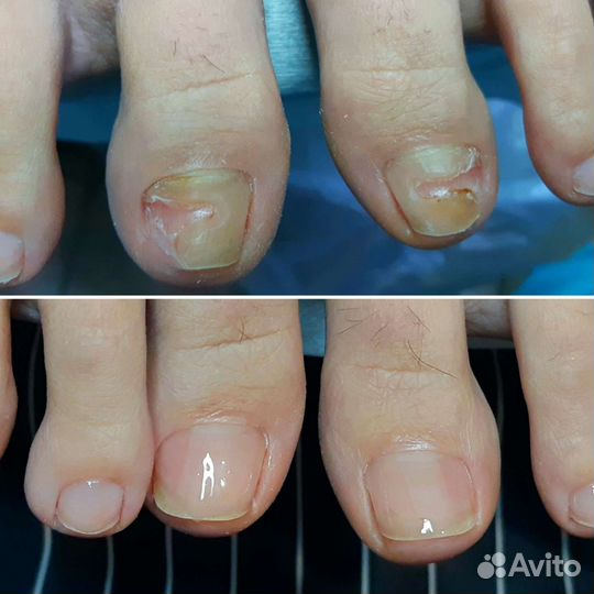 Подолог. Работа со сложными стопами и ногтями