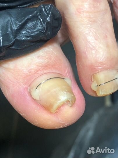 Лечебный маникюр,педикюр,грибок,трещины,грибок