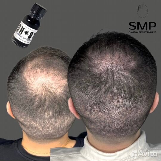 Мужская трихопигментация