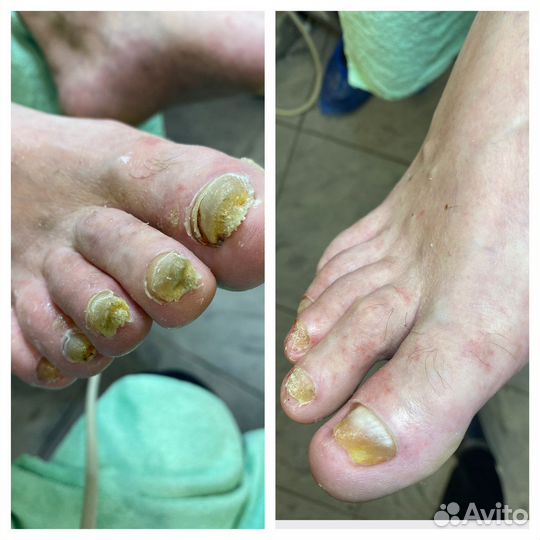 Медицинский педикюр,подолог