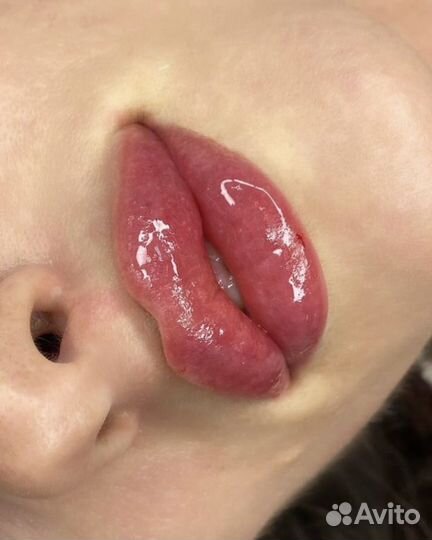 Контурная пластика губ