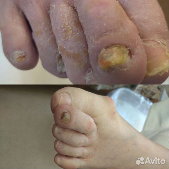 Медицинский педикюр подолог. Выезд на дом