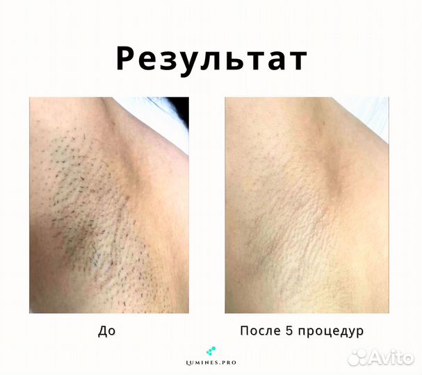 Аппарат для эпиляции люминес Макс’Ван 1200