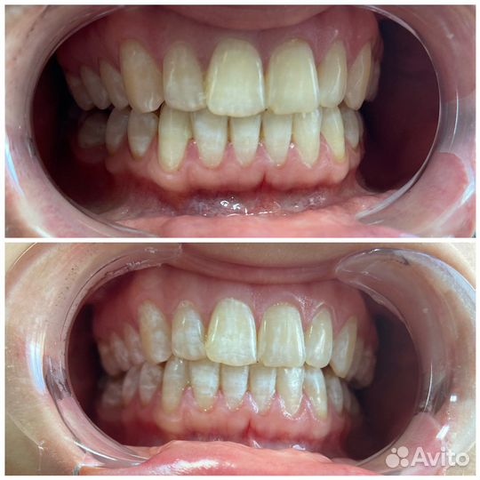 Косметическое отбеливание зубов