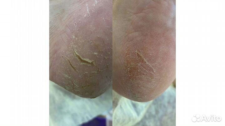 Педикюр. Медицинский педикюр. С выездом на дом