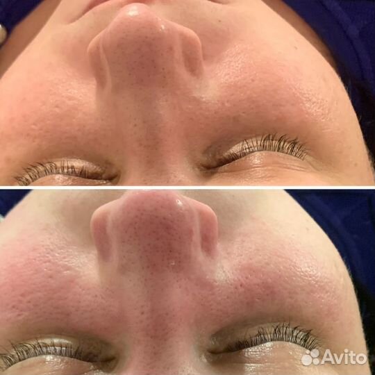 Массаж лица лифтинг и лимфодренаж