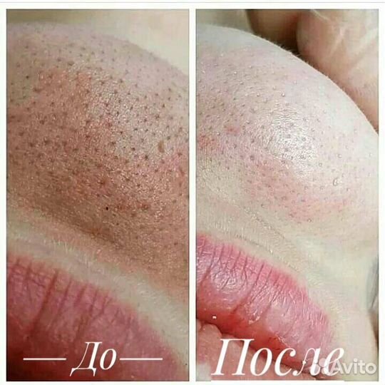 Гигиеническая чистка