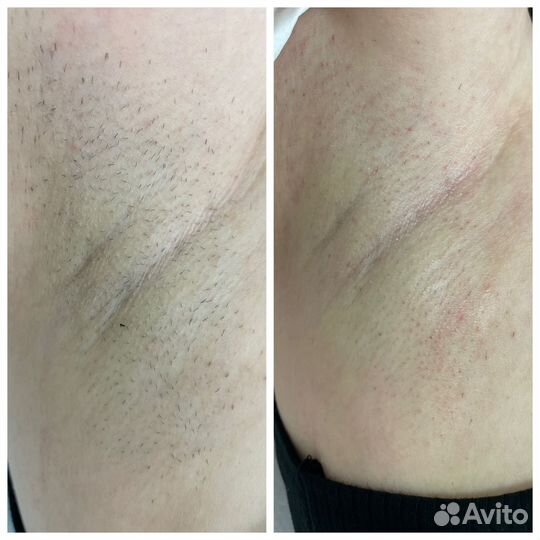 Электроэпиляция
