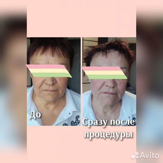 Морщин нет. Подтяну овал,веки. Смас-лифтинг