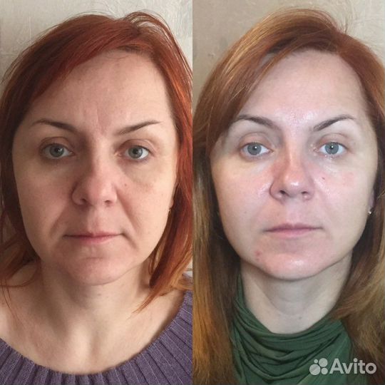 Скульптурно-буккальный массаж