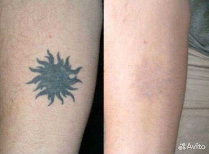 Удаление старого татуажа или тату