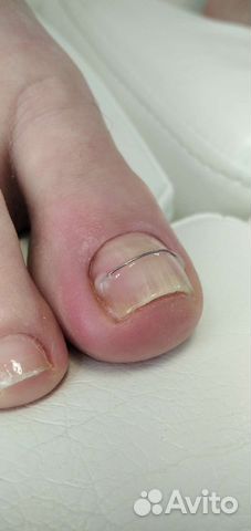 Обработка вросшего ногтя