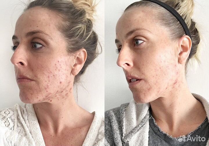 Комплексное лечения Акне /Дерматолог