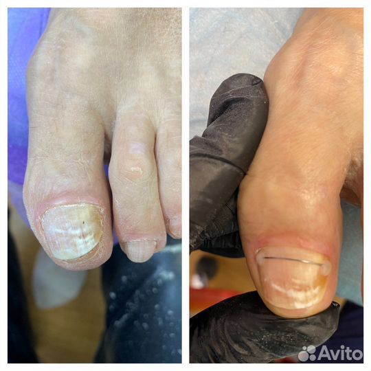 Медицинский педикюр,подолог