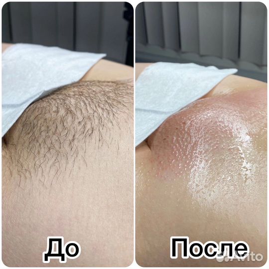 Депиляция воском
