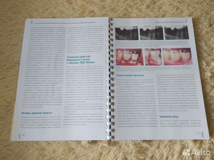 Регенерация пародонта