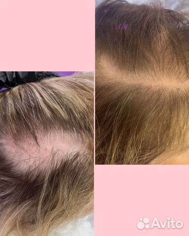 Мезотерапия от выпадения и восстановление волос