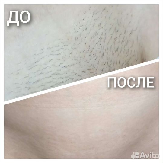 Шугаринг/Восковая депиляция/Ваксинг