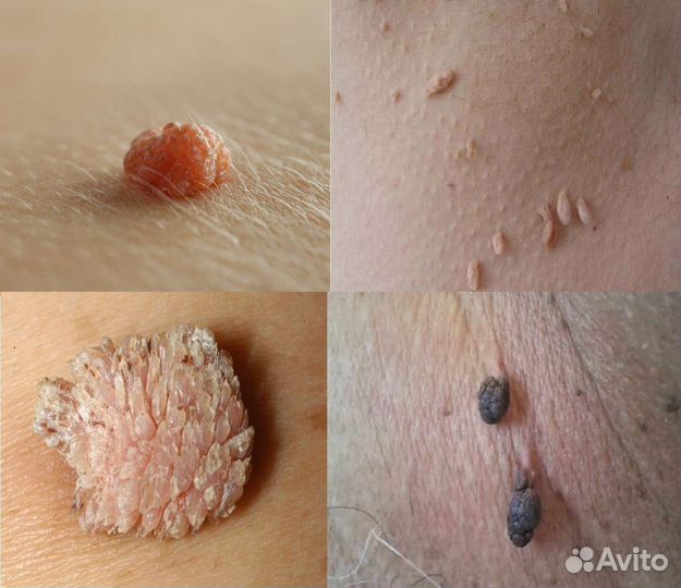 Удаление папиллом,родинок,бородавок