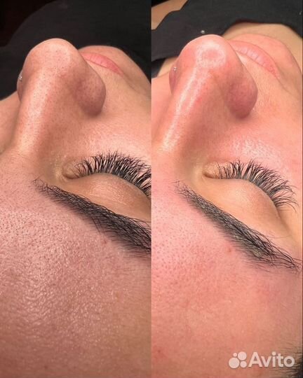 Чистка лица