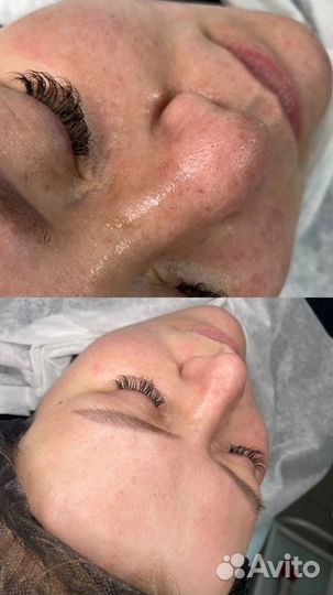 Чистка лица