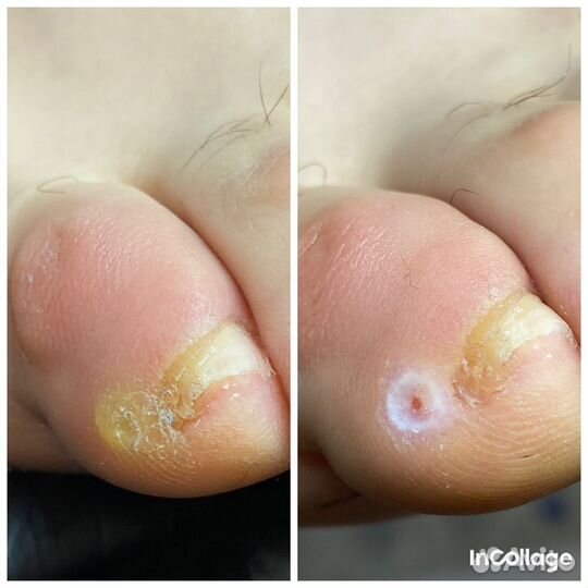 Удаление мозолей, бородавок, подолог