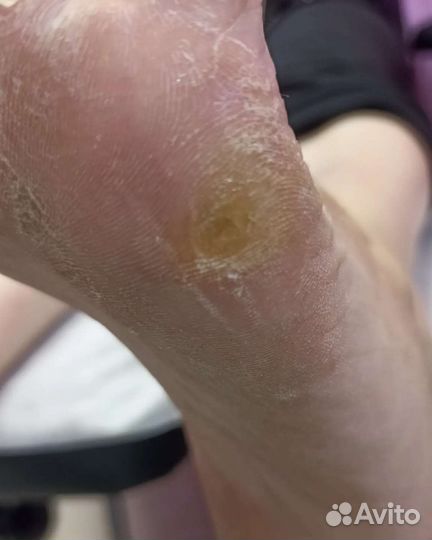 Подолог. Педикюр, вросший ноготь, сложные стопы