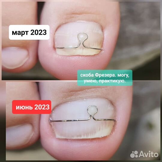 Лечебный педикюр подолог