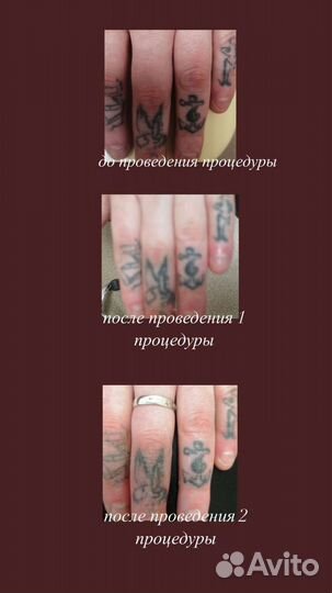 Удаление перманентного макияжа и тату