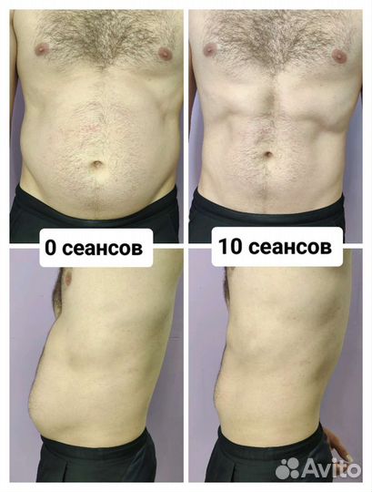 Кавитация/Коррекция фигуры