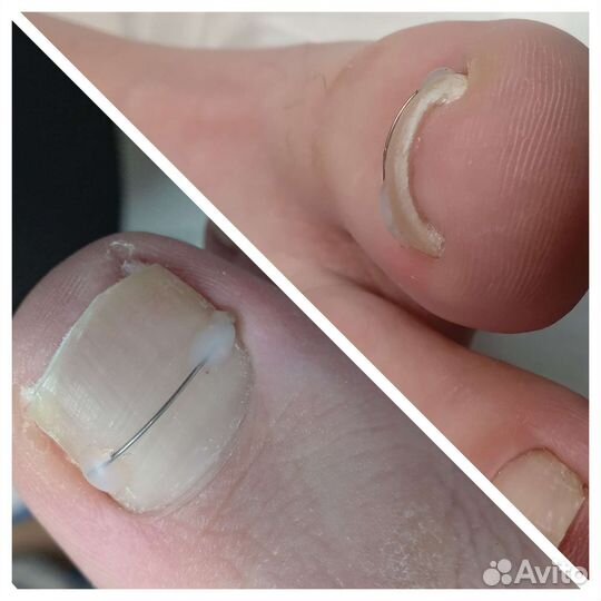 Подолог, выезд на дом(Мед.педикюр)шугар. депиляция