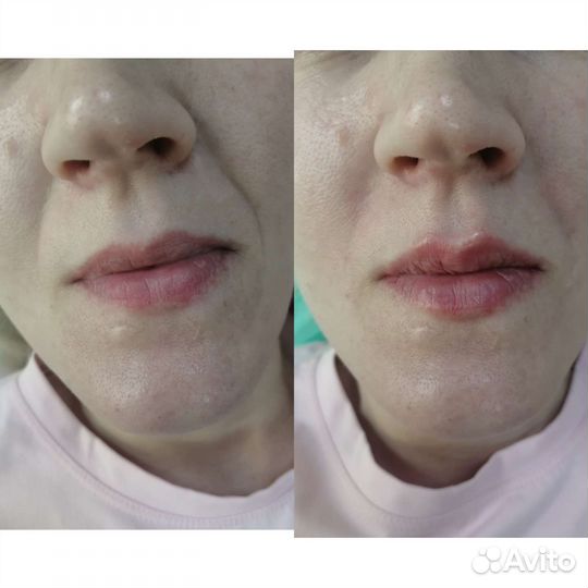 Косметолог, мезотерапия, биоревитализация, чистки