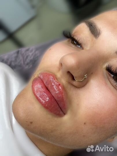 Увеличение губ, контурная пластика лица