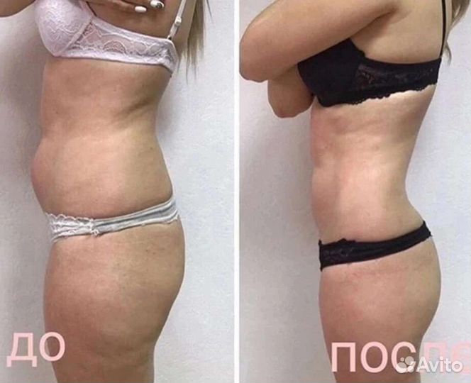 RET кавитация