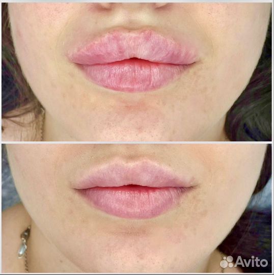 Коррекция губ, увеличение губ