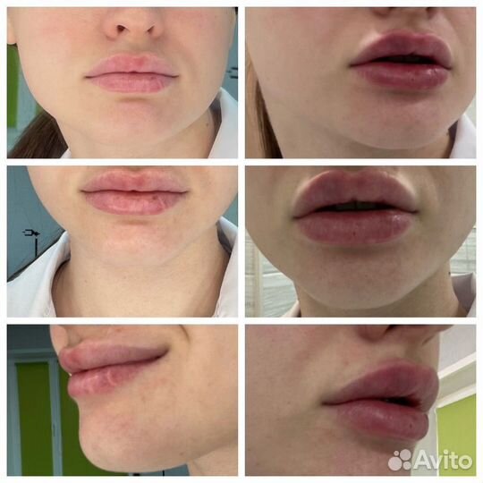 Увеличение губ, чистка лица