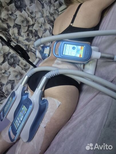 Криолиполиз